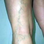 развития варикоза