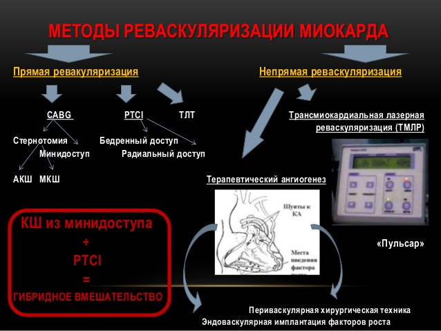 реваскуляризация миокарда