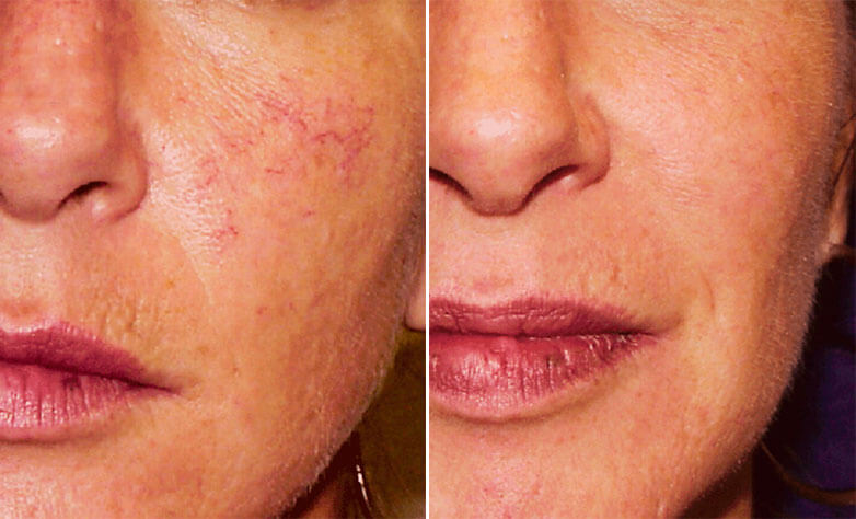 сосудистые звездочки