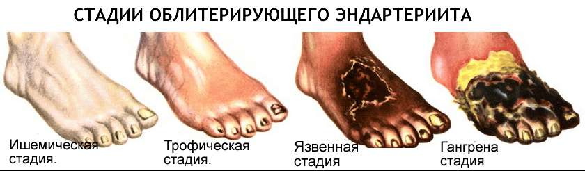 стадии эндатериита