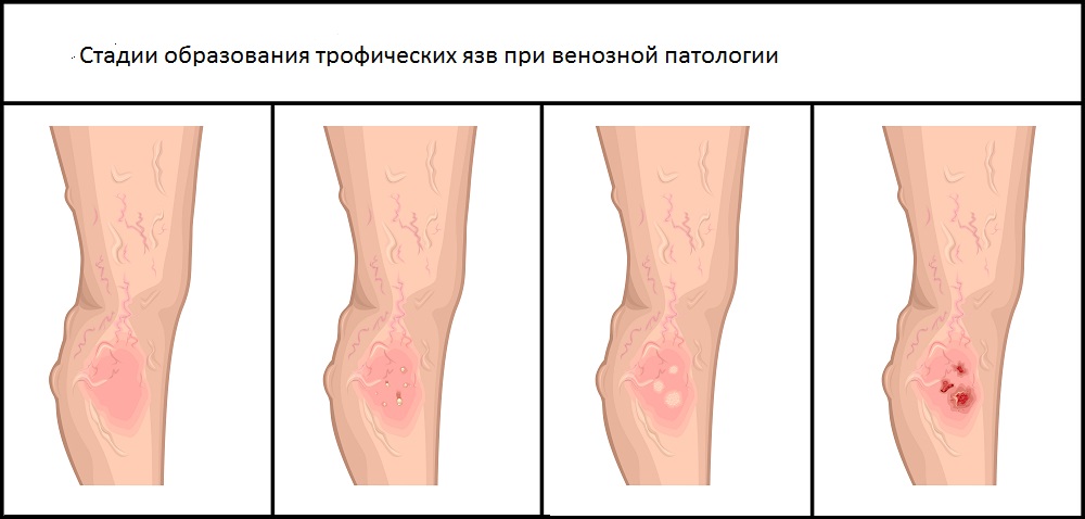 стадии образования язвы