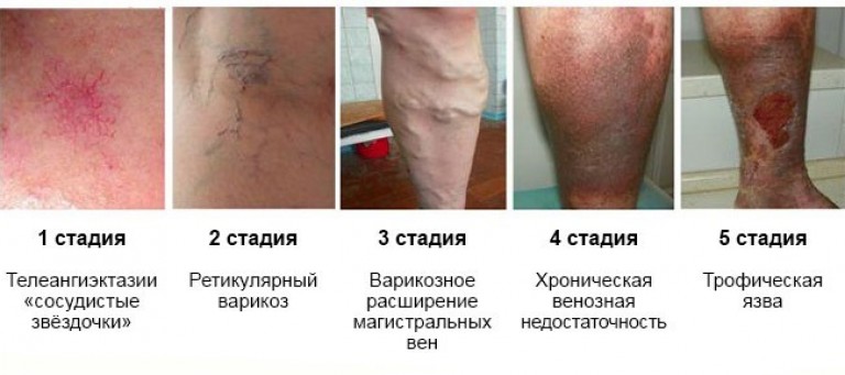 стадии варикоза