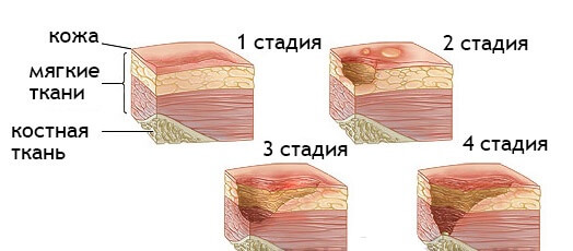 стадии язвы