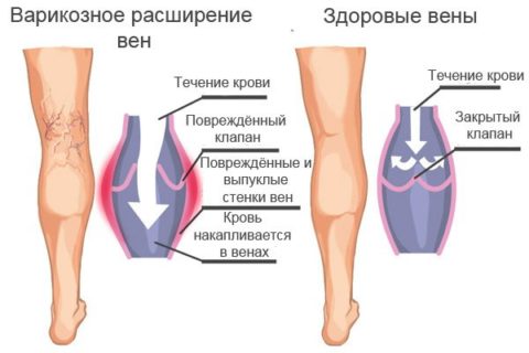 варикоз