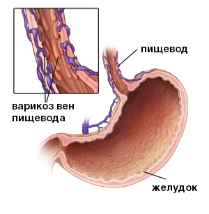 варикоз вен пищевода