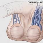варикозного расширения