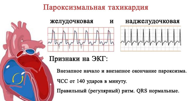 желудочковой и наджелудочковой тахикардии