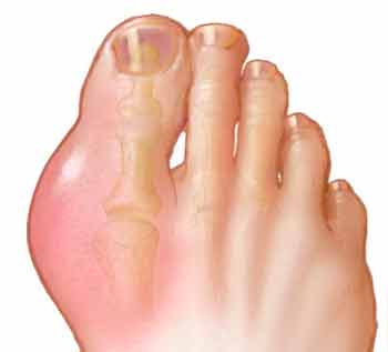 большой палец ноги, пораженный подагрой