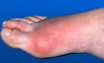 подагра на большом пальце ноги