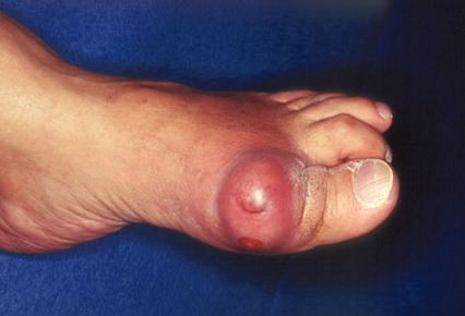 большой палец ноги с огромным подагрическим тофусом