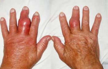 подагра на руках