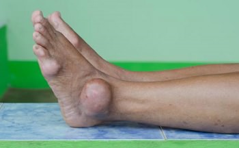 нога, пораженная подагрическим артритом