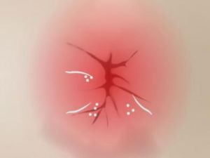 Покраснение вокруг анальности у ребенка. Причины возникновения и методы лечения Покраснение вокруг анальности у ребенка. Причины возникновения и методы лечения