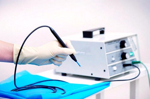 Диатермокоагуляция