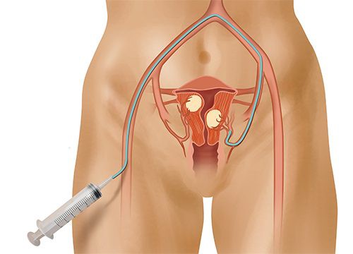 Эмболизация