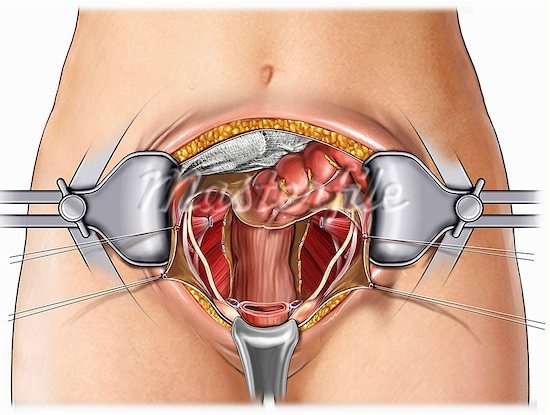Гистерэктомия