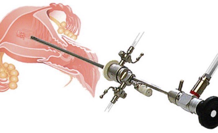 Гистероскопия