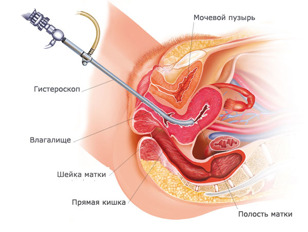 Гистероскопия