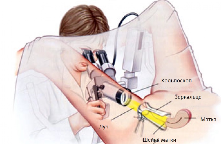 кольпоскопия