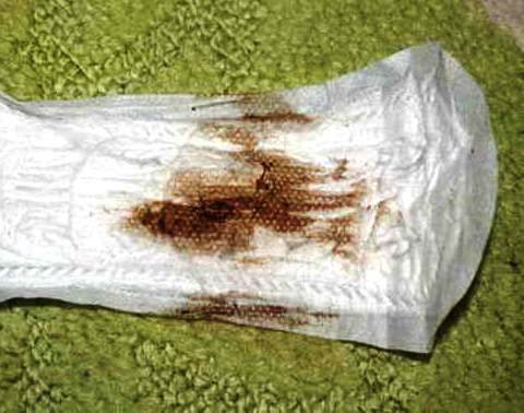 Кровянистые выделения от свечек