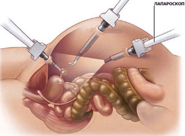 Лапароскопия