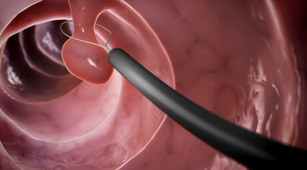 Плацентарный полип