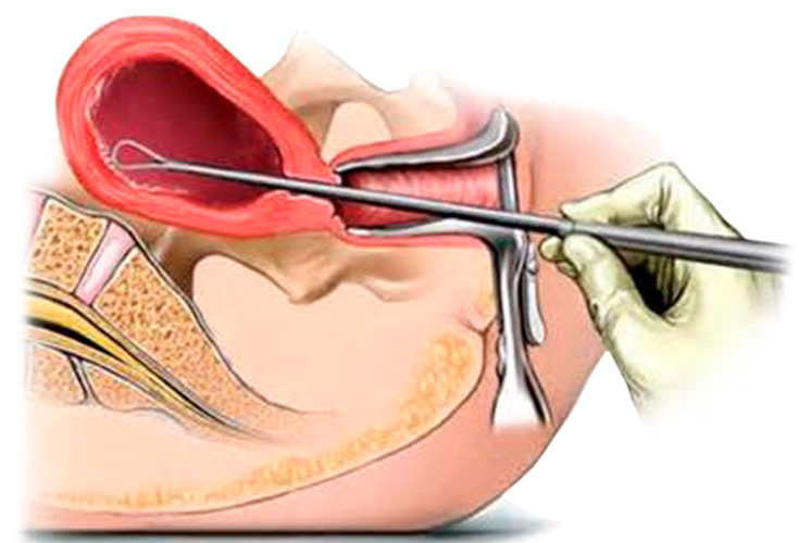 Выскабливание