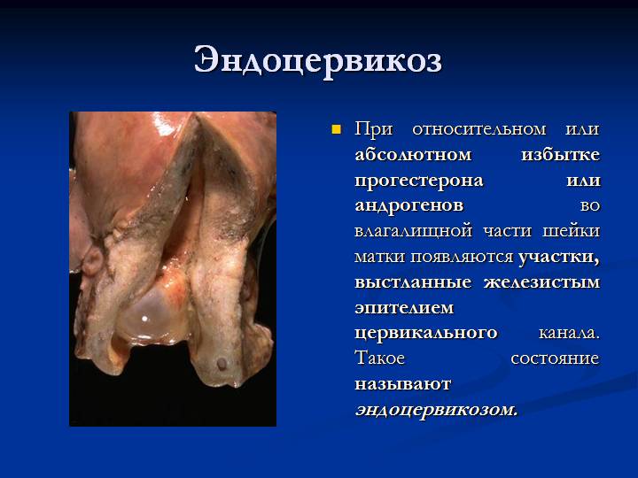 что такое эндоцервикоз