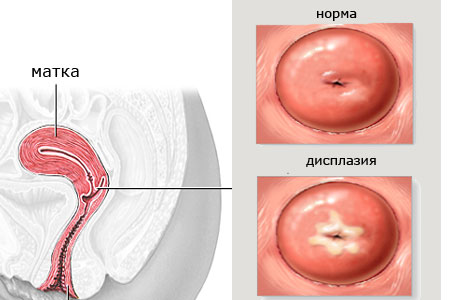дисплазия шейки матки