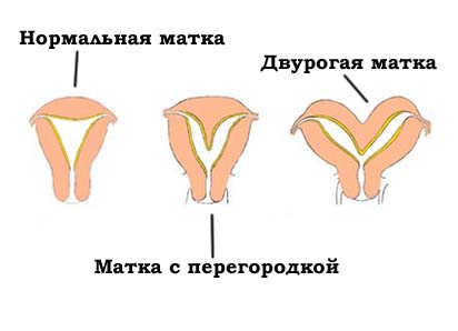 Можно ли забеременеть при двурогой матке