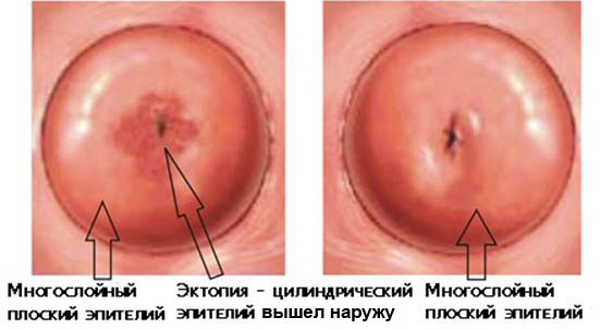 эктопия это