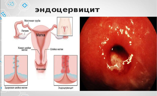 Что такое эндоцервицит шейки матки