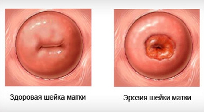эрозия шейки матки