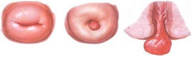 формы полипов