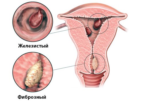 формы полипов
