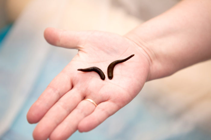 гирудотерапия