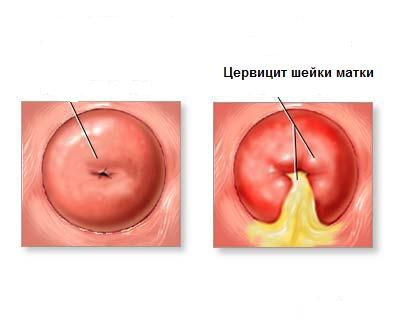 хронический цервикоз