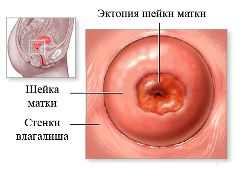 как выглядит эндоцервикоз
