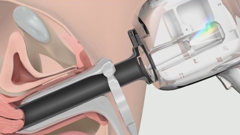 кольпоскопия