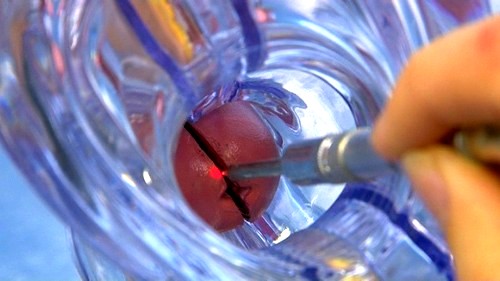 лечение эндоцервикоза