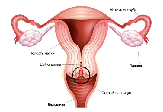 Какое лечение назначается при хроническом и остром цервиците
