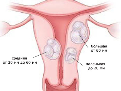 размеры миомы