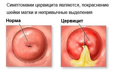 Какое лечение назначается при хроническом и остром цервиците