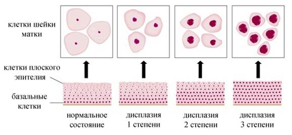 степени дисплази шейки матки