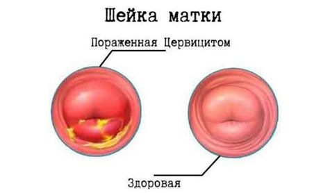 Какое лечение назначается при хроническом и остром цервиците
