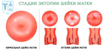 виды эктопии