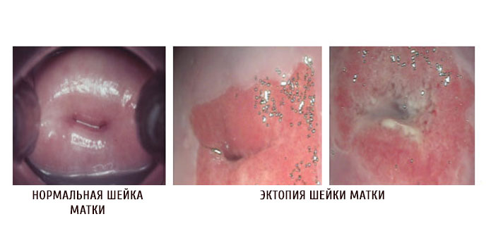 виды эрозии шейки матки