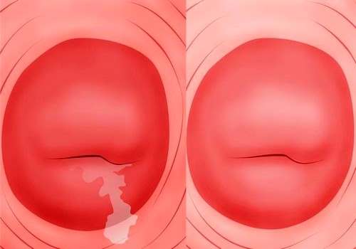 Что такое эндоцервицит шейки матки