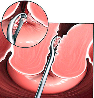 Как проводится диагностические выскабливание полости матки при гиперплазии эндометрия