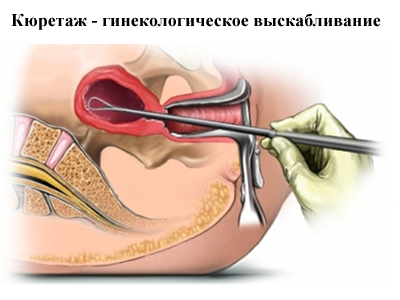 выскабливание